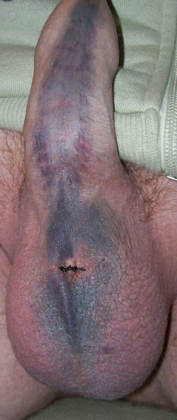 Bruised Penis After Sex 11