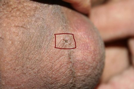 Vasectomy incision close-up on the left testicle (day 6)