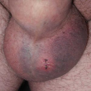 Typical bruising after no-scalpel vasectomy on day 5